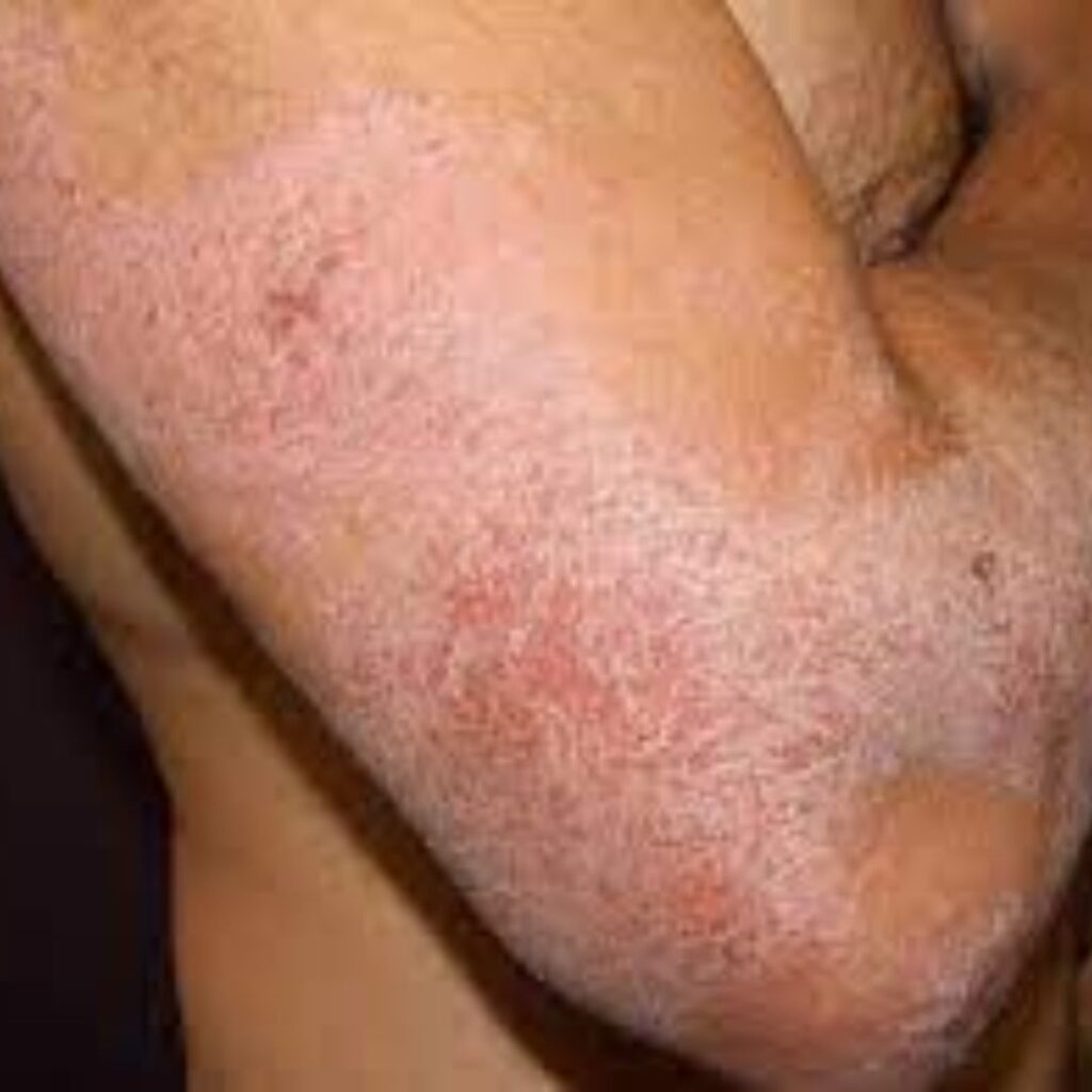 Atopic dermatitis