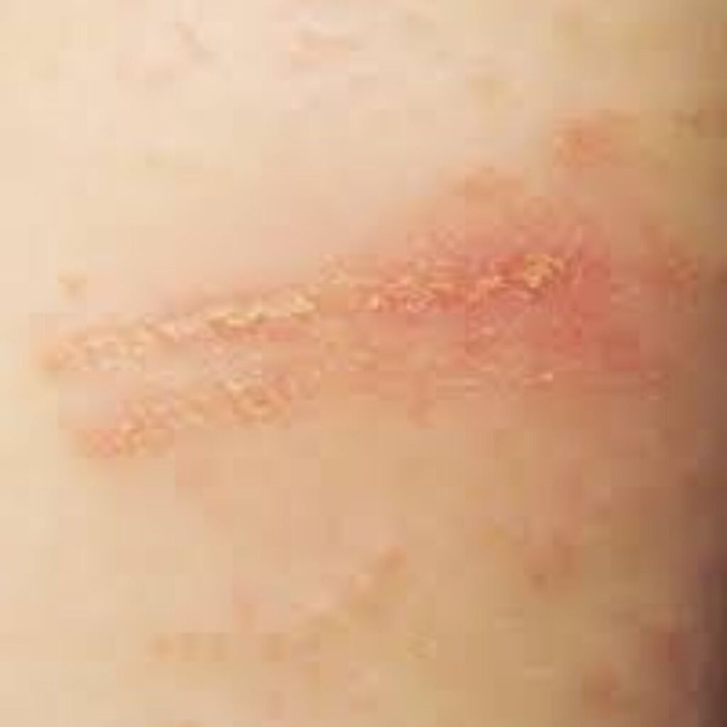 How to cure eczema easily