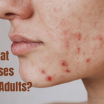 What Causes Acne in Adults?