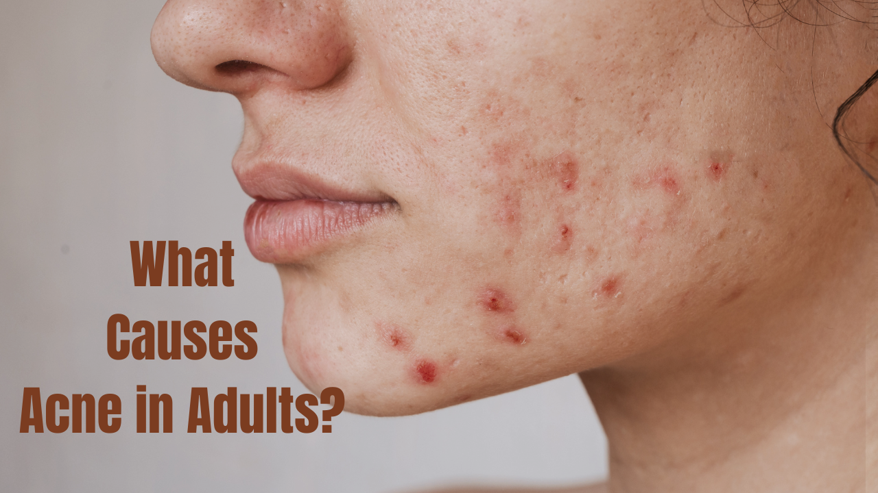 What Causes Acne in Adults?